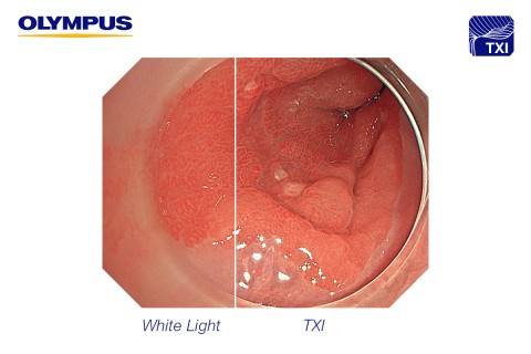 Olympus_EVIS-X1_White Light vs. TXI_72dpi